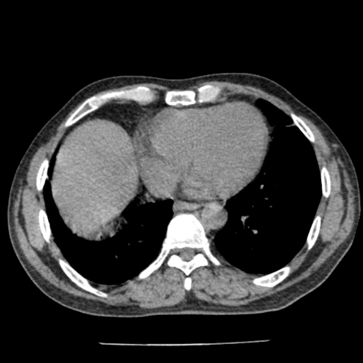 Airway foreign body in adult (Radiopaedia 85907-101779 Axial liver window 133).jpg