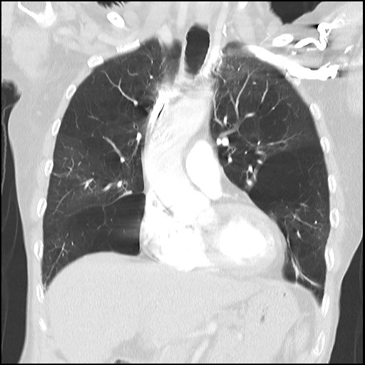 File:Alpha-1-antitrypsin deficiency (Radiopaedia 64893-73840 Coronal lung window 13).jpg