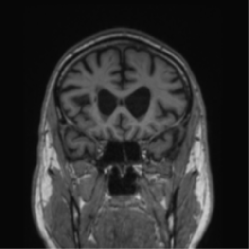 Alzheimer's disease- with Gerstmann syndrome and dressing apraxia (Radiopaedia 54882-61150 Coronal T1 64).png