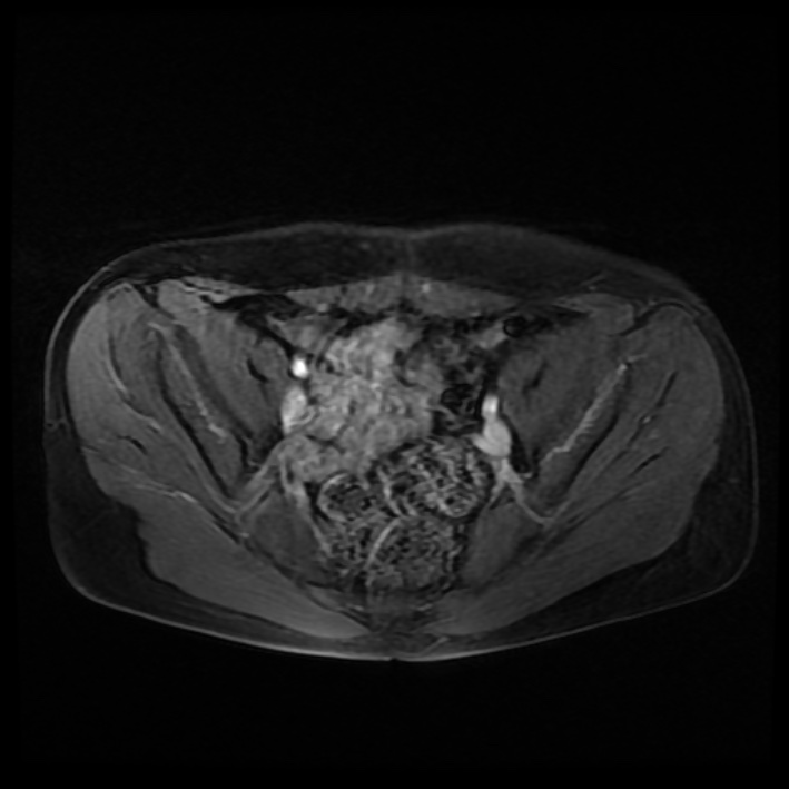 Ambiguous genitalia (Radiopaedia 69686-79643 Axial T1 C+ fat sat 18).jpg