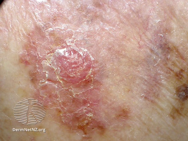 File:Amelanotic melanoma on the back (DermNet NZ amelanotic-melanoma-63-of-126).jpg