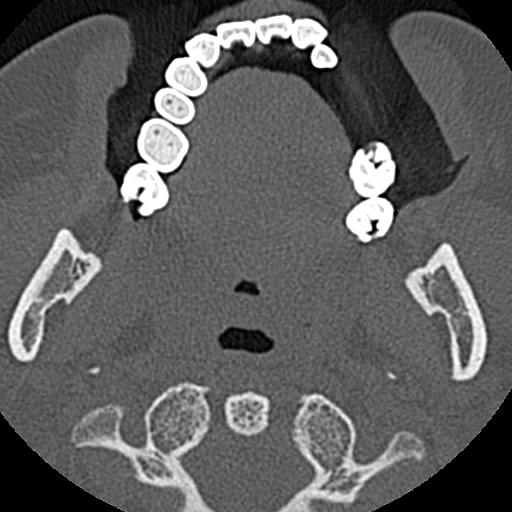 Ameloblastic fibro-odontoma (Radiopaedia 18843-18780 C 54).jpg