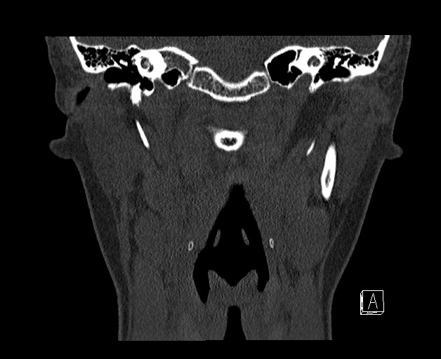 File:Ameloblastoma (Radiopaedia 26645-26793 bone window 24).jpg