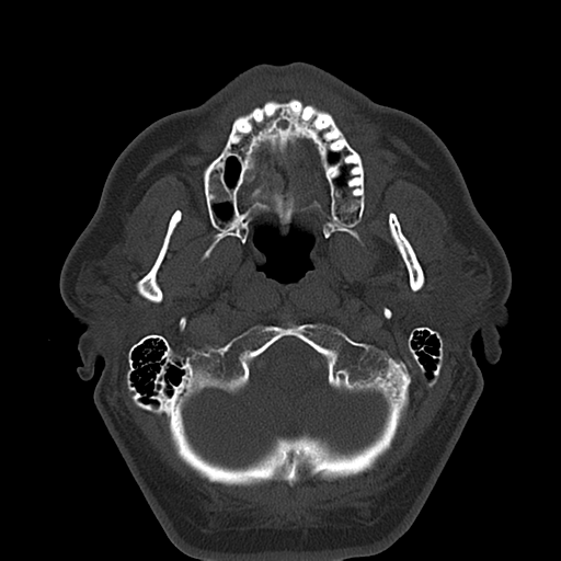 Ameloblastoma (Radiopaedia 38520-40623 Axial bone window 20).png
