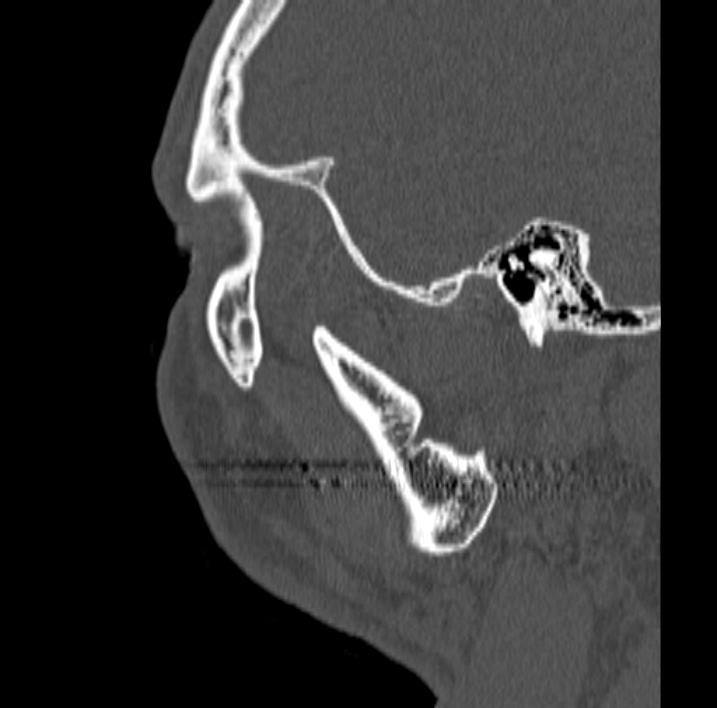 Ameloblastoma (Radiopaedia 77750-89997 Sagittal bone window 100).jpg
