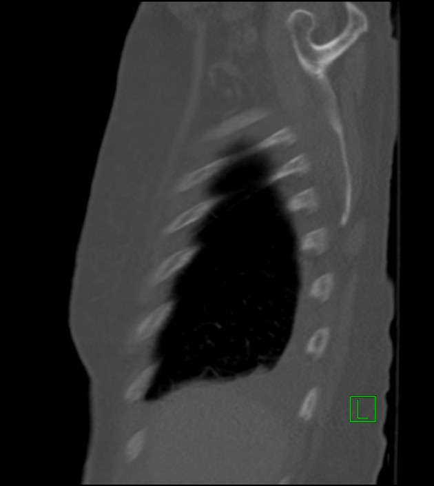 Amiodarone deposition in the liver (Radiopaedia 77587-89780 Sagittal bone window 84).jpg
