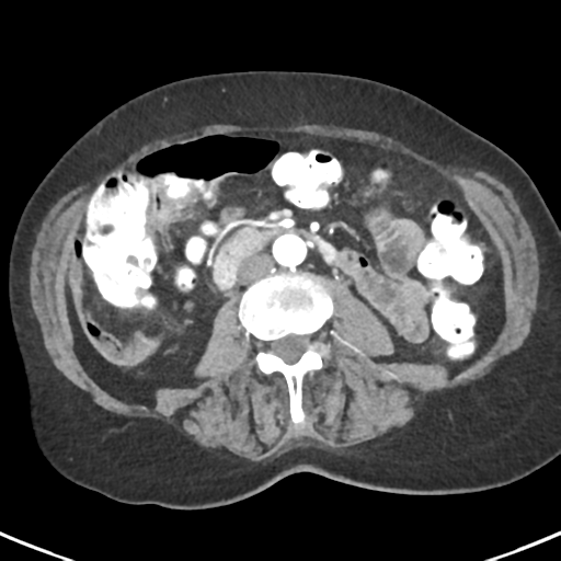 File:Ampullary adenocarcinoma (Radiopaedia 34013-35237 B 51).png