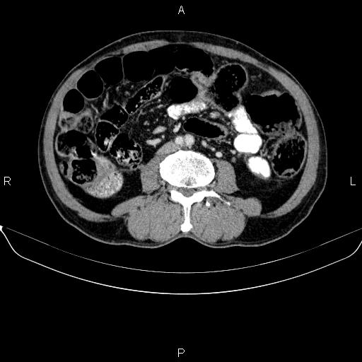 Ampullary adenocarcinoma (Radiopaedia 86093-102032 A 33).jpg