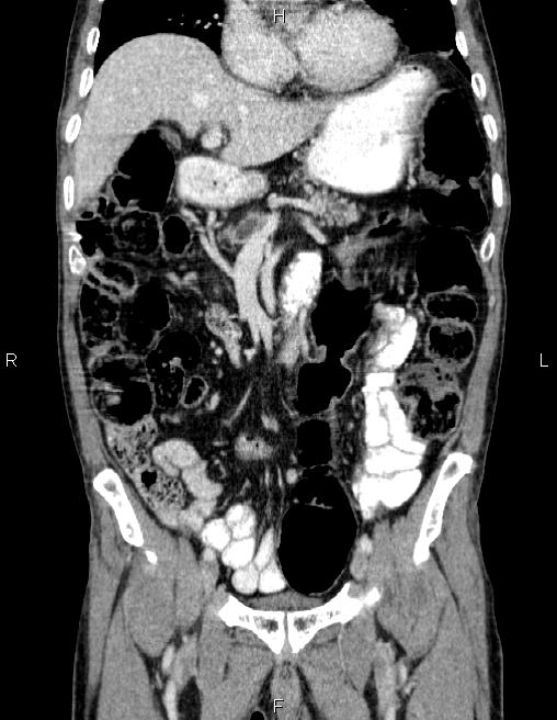 Ampullary adenocarcinoma (Radiopaedia 86093-102032 C 27).jpg