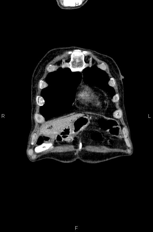 Ampullary adenocarcinoma (Radiopaedia 86093-102033 D 3).jpg