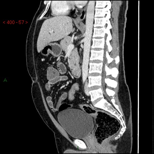 Ampullary carcinoma (Radiopaedia 56396-63056 D 56).jpg