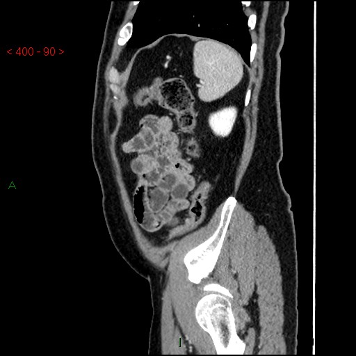 Ampullary carcinoma (Radiopaedia 56396-63056 D 89).jpg