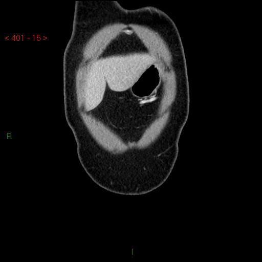 Ampullary carcinoma (Radiopaedia 56396-63056 E 14).jpg