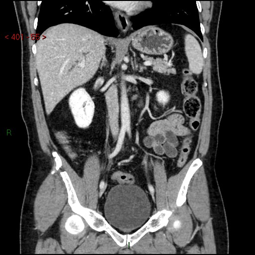Ampullary carcinoma (Radiopaedia 56396-63056 E 54).jpg