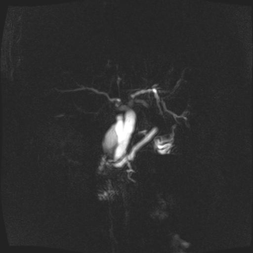 File:Ampullary tumor (Radiopaedia 27294-27479 3D MRCP images 1).jpg