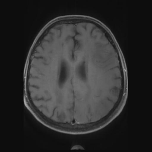 File:Amyloid angiopathy with inflammation (Radiopaedia 30360-31002 Axial T1 C+ fat sat 22).jpg