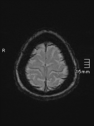 Amyotrophic lateral sclerosis (Radiopaedia 70821-81017 Axial SWI 53).jpg