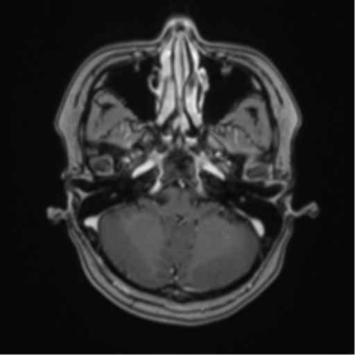 Anaplastic astroblastoma (Radiopaedia 55666-62194 Axial T1 C+ 16).png