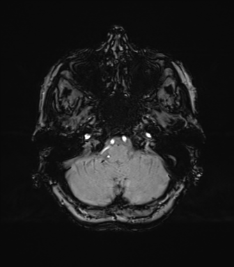 Anaplastic astrocytoma (Radiopaedia 86943-103160 Axial SWI 18).png