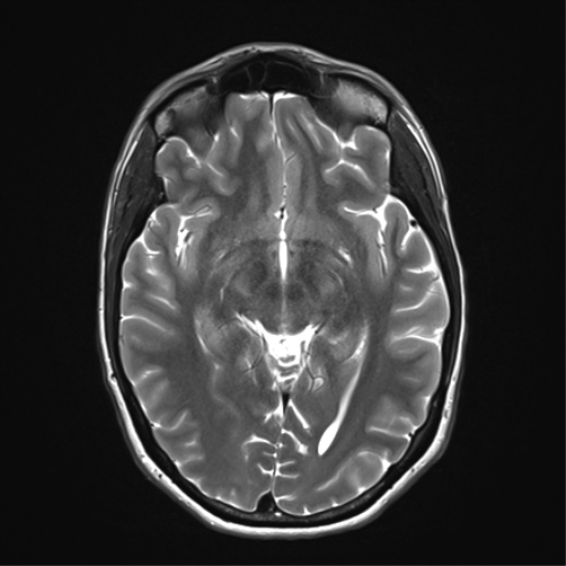 File:Anaplastic astrocytoma IDH mutant (Radiopaedia 50046-55341 Axial T2 18).png