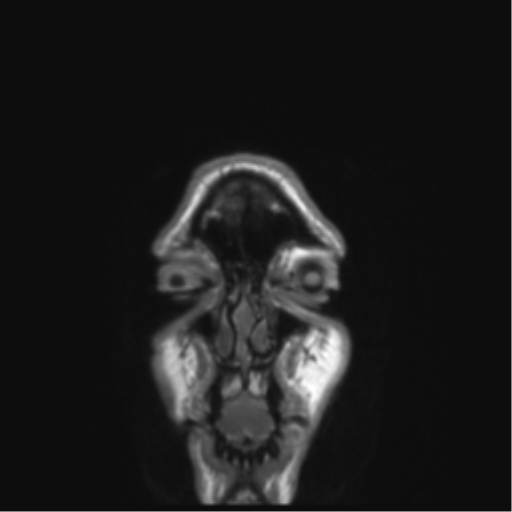 Anaplastic astrocytoma IDH mutant (Radiopaedia 50046-55341 Coronal T1 59).png