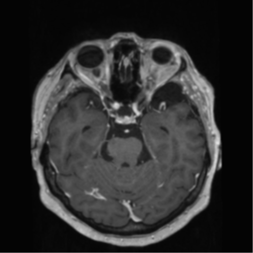 File:Anaplastic astrocytoma IDH wild-type (pseudoprogression) (Radiopaedia 42209-45278 Axial T1 C+ 61).png