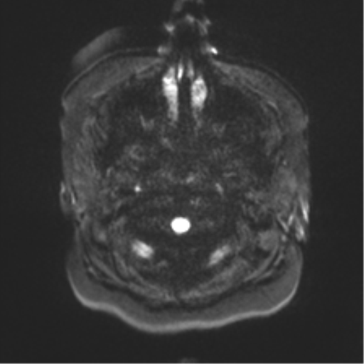 File:Anaplastic astrocytoma IDH wild-type (pseudoprogression) (Radiopaedia 42209-45279 Axial DWI 28).png