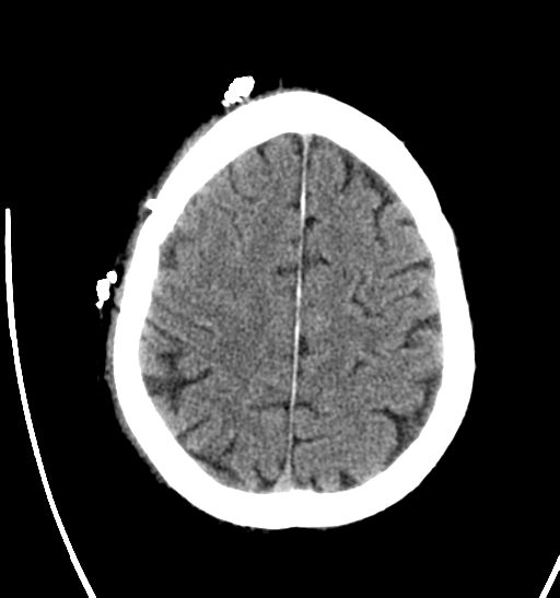 File:Anaplastic meningioma with recurrence (Radiopaedia 34452-35786 Axial non-contrast 25).png