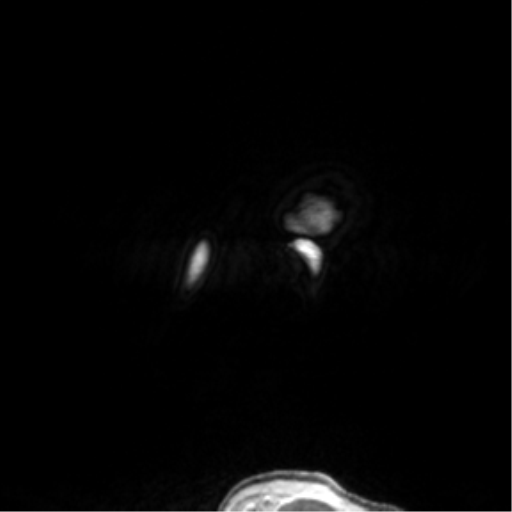 Anaplastic oligodendroglioma (Radiopaedia 83500-98599 Sagittal T1 C+ 7).png