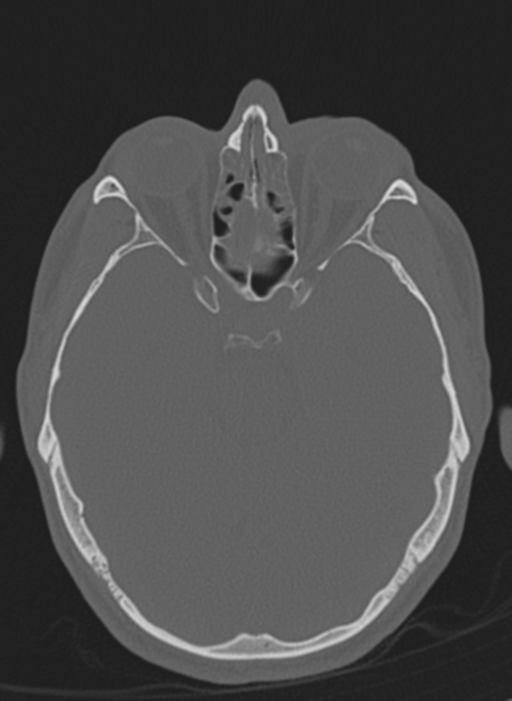 Anaplastic oligodendroglioma with skull fracture (Radiopaedia 74831-85846 Axial bone window 48).png
