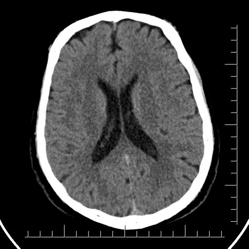 Aneurysm of posterior communicating artery (Radiopaedia 20188-20162 Axial non-contrast 29).jpg