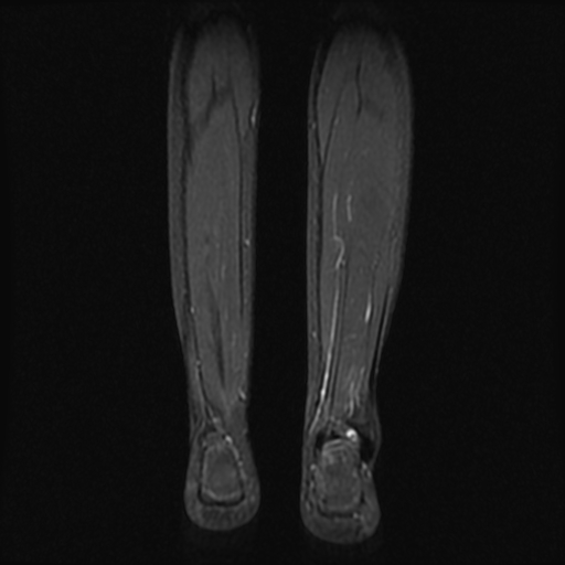 File:Aneurysmal bone cyst - tibia (Radiopaedia 22343-22367 Coronal STIR 15).jpg