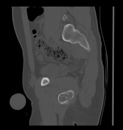 Aneurysmal bone cyst of ischium (Radiopaedia 25957-26094 Sagittal bone window 46).png