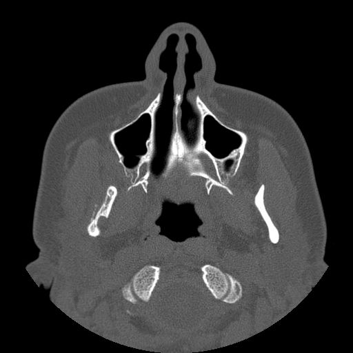 File:Aneurysmal bone cyst of the mandible (Radiopaedia 43280-46823 Axial bone window 106).jpg