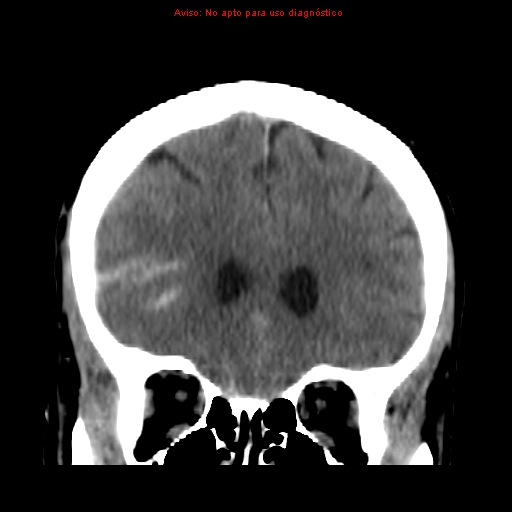 File:Aneurysmal subarachnoid hemorrhage (Radiopaedia 24740-24997 Coronal non-contrast 12).jpg