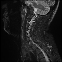 File:Ankylosing spondylitis - shiny corner sign (Radiopaedia 52084-57939 Sagittal T2 8).jpg