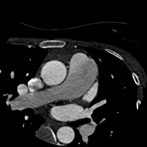 Anomalous left coronary artery from the pulmonary artery (ALCAPA) (Radiopaedia 40884-43586 A 5).jpg