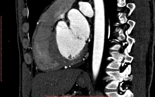 Anomalous left coronary artery from the pulmonary artery (ALCAPA) (Radiopaedia 70148-80181 C 142).jpg