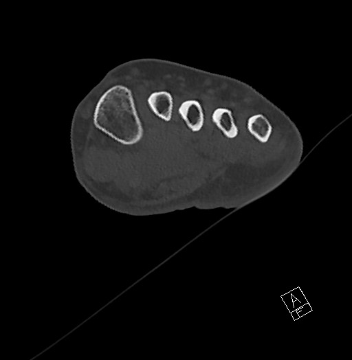 Anterior calcaneal process fracture (Radiopaedia 63353-71943 Axial bone window 62).jpg