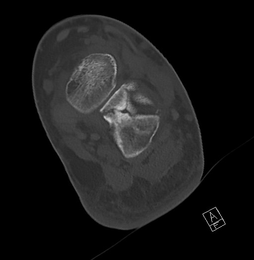 Anterior calcaneal process fracture (Radiopaedia 63353-71943 Axial bone window 93).jpg