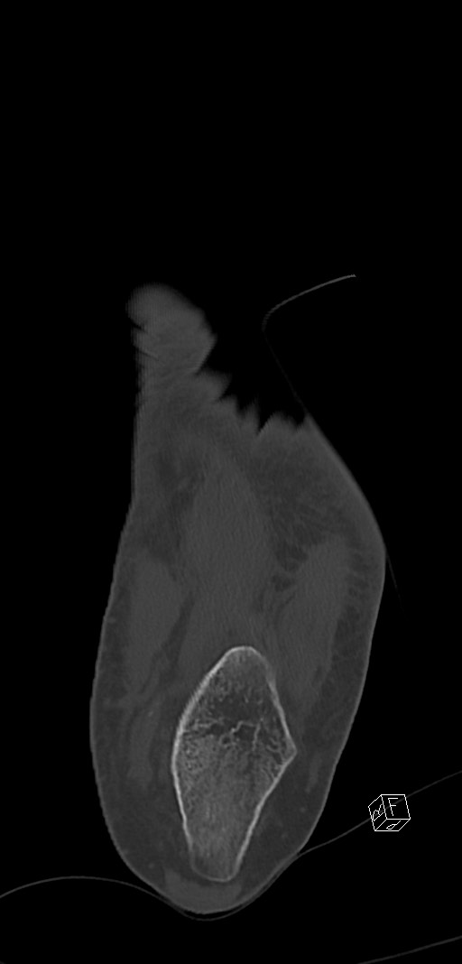 Anterior calcaneal process fracture (Radiopaedia 63353-71943 Coronal bone window 38).jpg