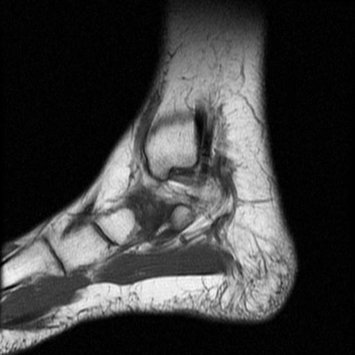 File:Anterior calcaneal process fracture (Radiopaedia 71377-81705 Sagittal T1 14).jpg