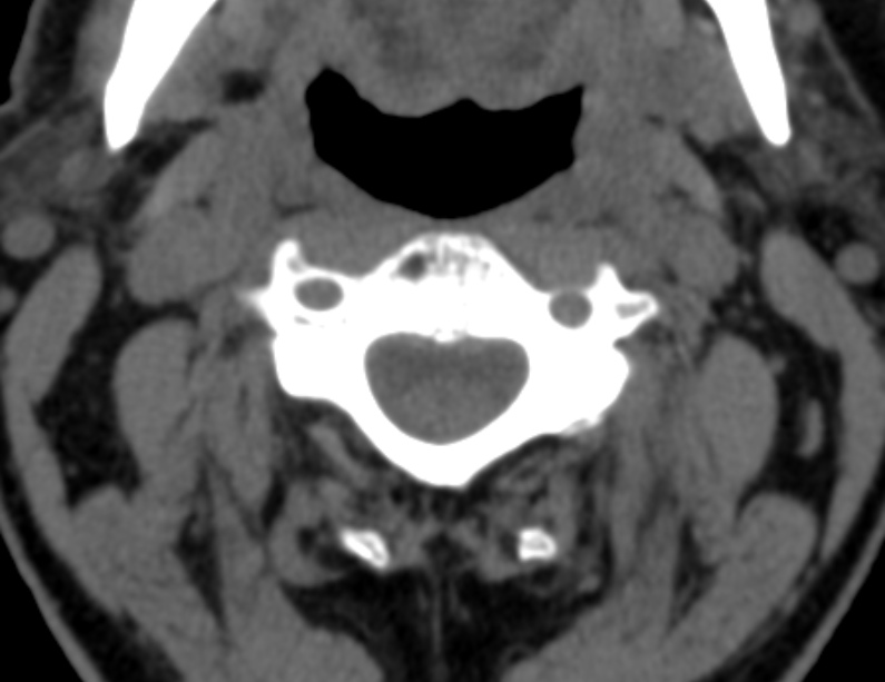 Anterior cervical postdiscectomy arthrodesis (Radiopaedia 32678-33646 Axial non-contrast 27).jpg