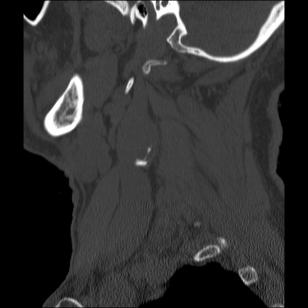 Anterior cervical postdiscectomy arthrodesis (Radiopaedia 32678-33646 Sagittal bone window 3).jpg