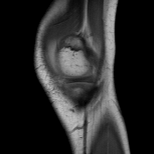 File:Anterior cruciate ligament avulsion fracture (Radiopaedia 24710-24974 Sagittal T1 1).jpg