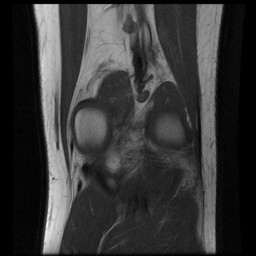 File:Anterior cruciate ligament tear (Radiopaedia 61500-69462 Coronal T1 17).jpg
