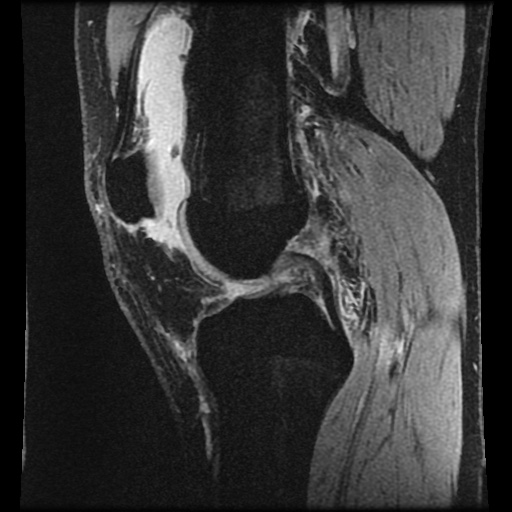 File:Anterior cruciate ligament tear (Radiopaedia 61500-69462 F 39).jpg