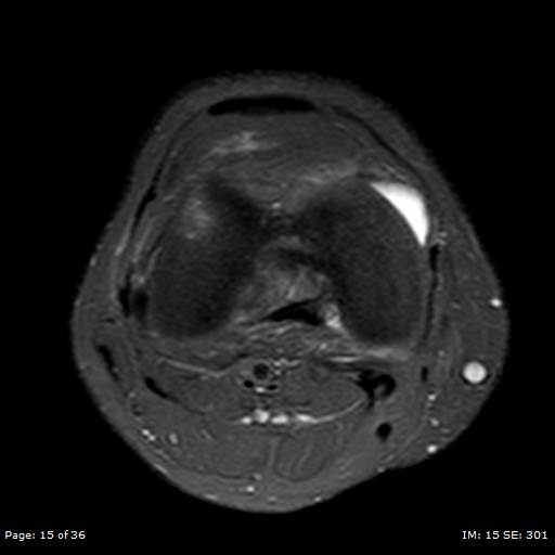 File:Anterior cruciate ligament tear (Radiopaedia 70783-80964 Axial PD fat sat 15).jpg