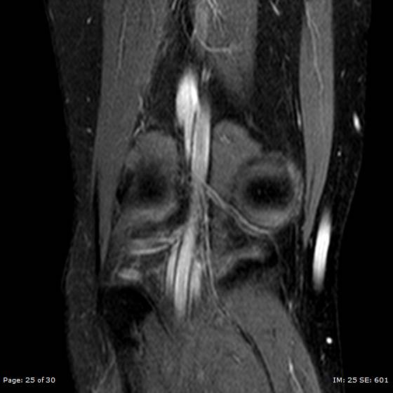 File:Anterior cruciate ligament tear (Radiopaedia 70783-80964 Coronal STIR 25).jpg