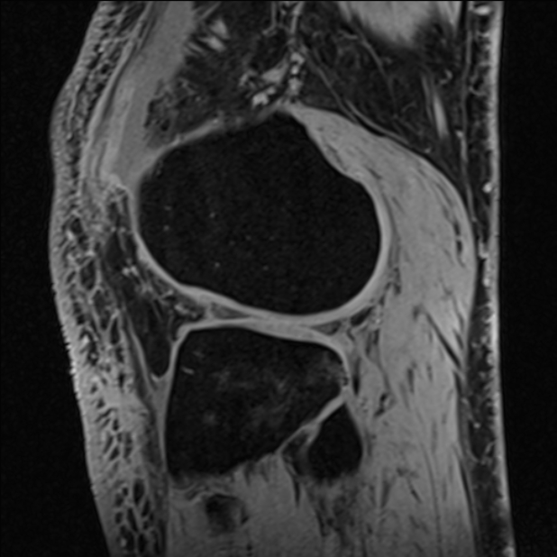 Anterior cruciate ligament tear - ramp lesion (Radiopaedia 71883-82322 Sagittal T1 vibe 40).jpg